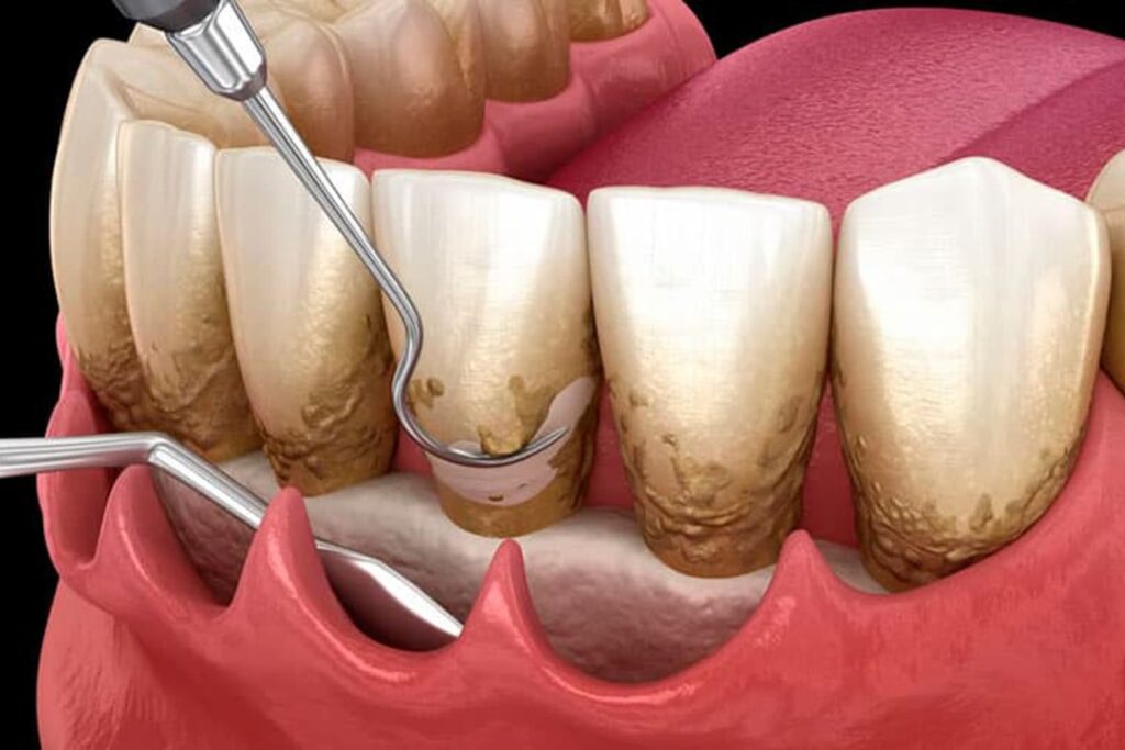 Cirugia-Periodontal-con-Colgajo-portada (3)