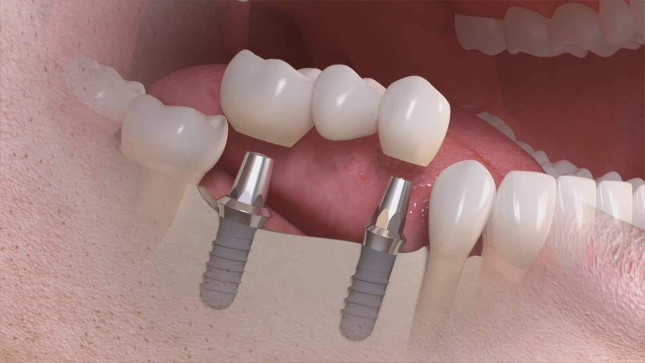 Protesis-implantosoportada-fija (1)